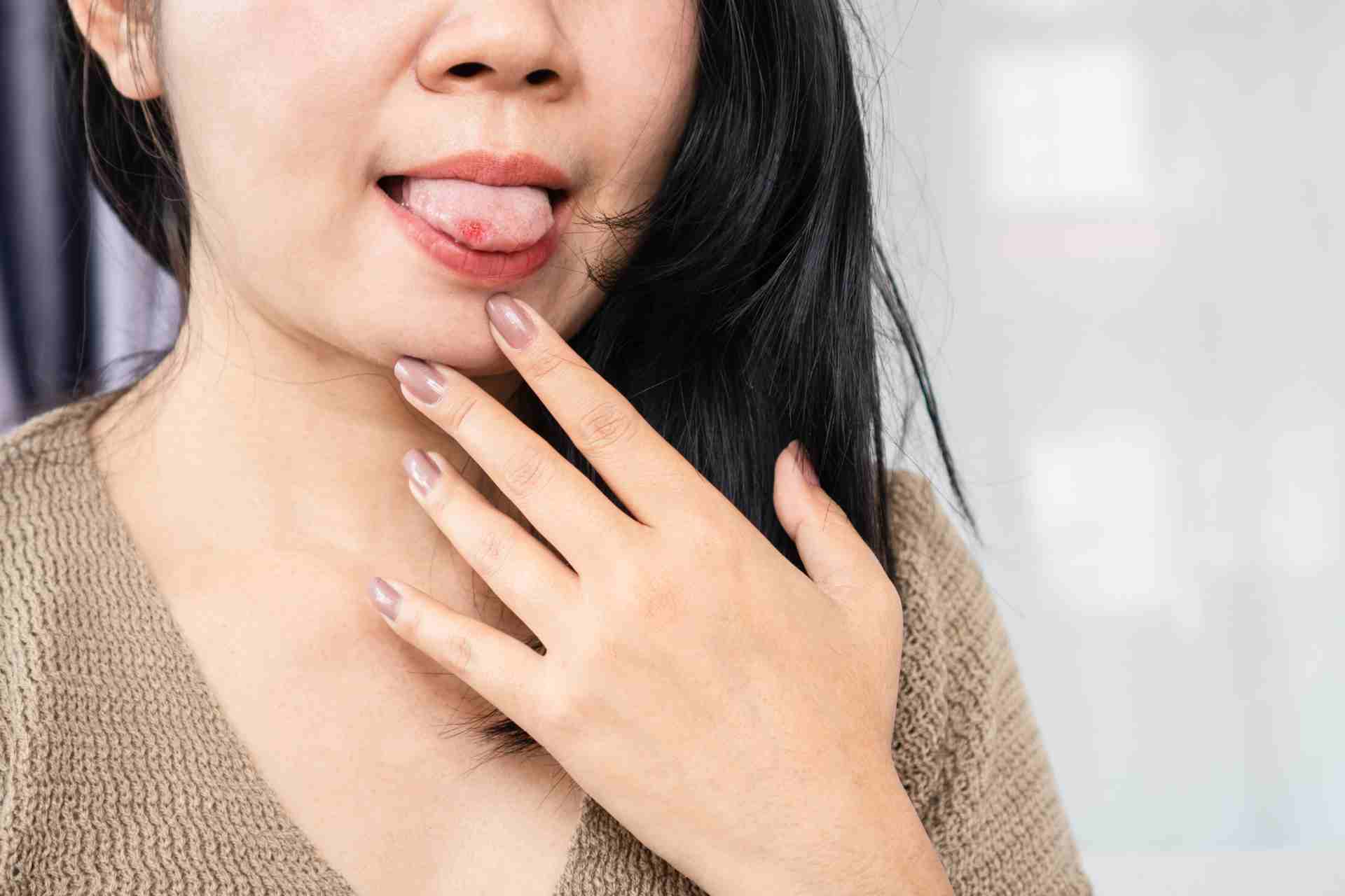 How To Get Rid of Blister on Tongue?