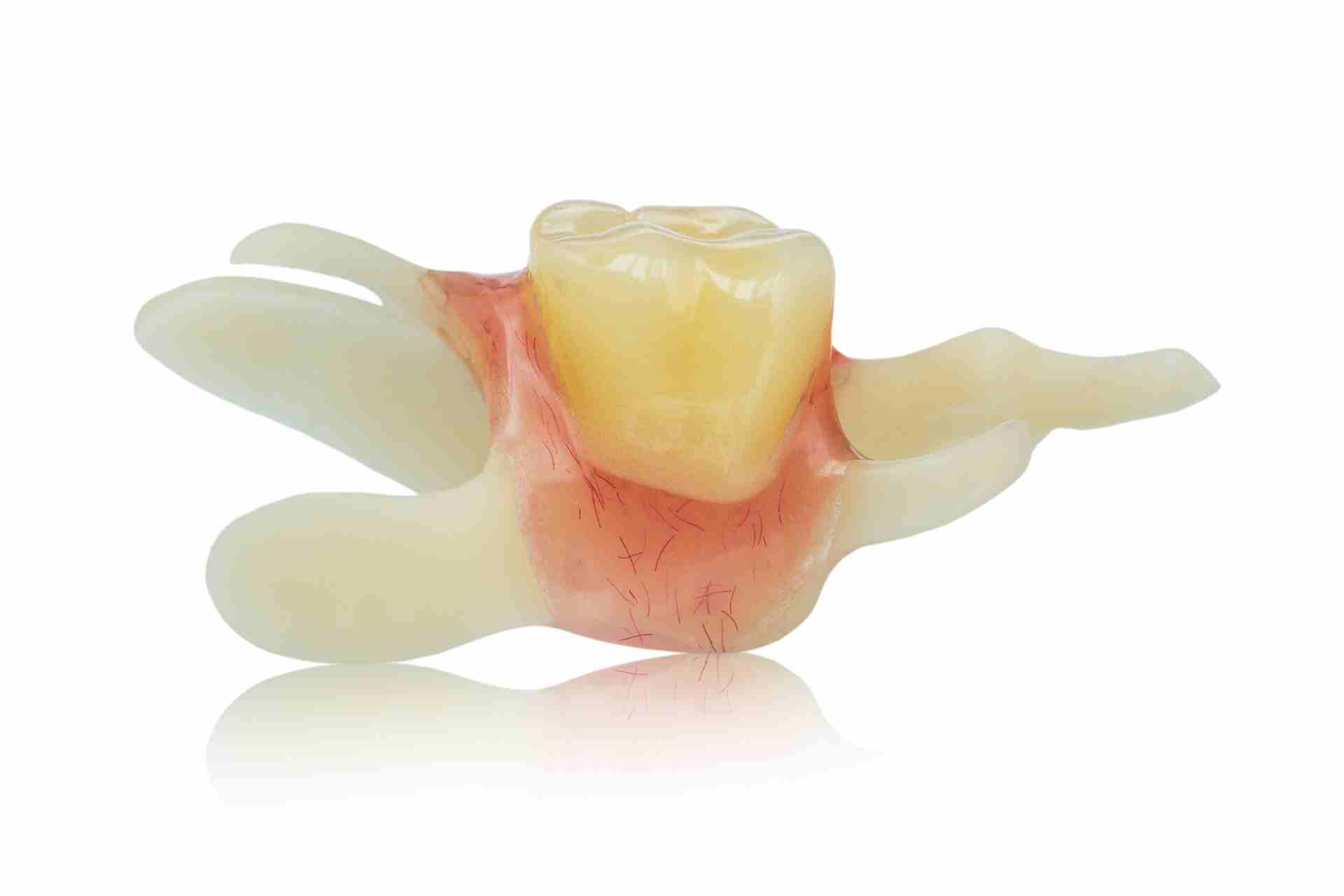 How Does a Single Tooth Denture Stay In?